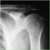 Skiagrafický snímek ramene