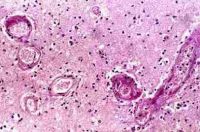 Radiační poškození cévy