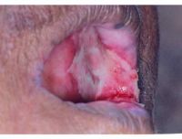 Postradiační stomatitida