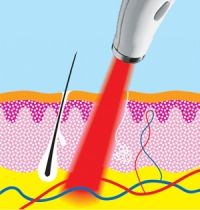 Aplikace terapeutického laseru