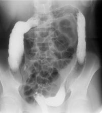 Kontrastní vyšetření tlustého střeva (irrigografie)